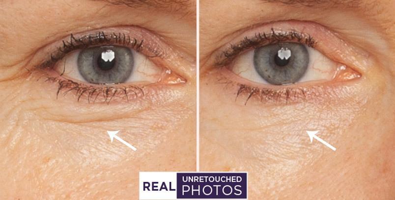 Before and after photos showing under eye results from Meaningful Beauty